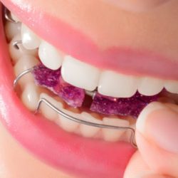 Woman wearing orthodontic removable brac