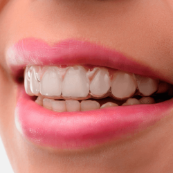 o-que-e-invisalign-19032018104002