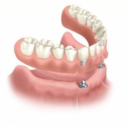 overdenture