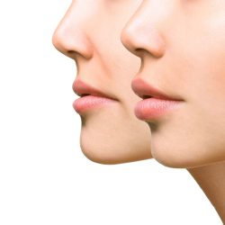preenchimento-labial-scaled.jpg