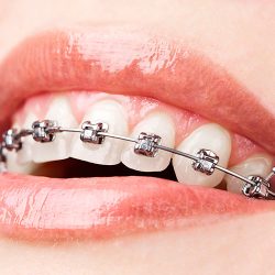 teeth-with-braces-edit-1