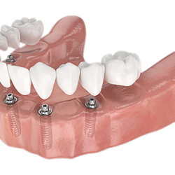 tooth-all-on-4-dental-implant-dentistry-edentulism-implant-tooth-2-1.png